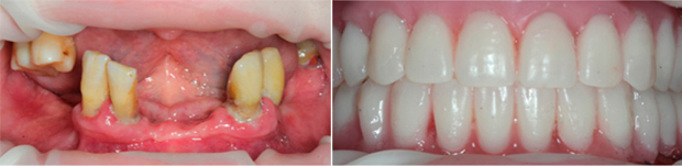 имплантация зубов при пародонтите
