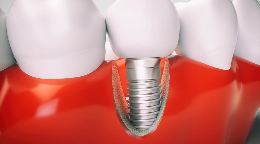 как поведут себя зубные импланты при проведении мрт